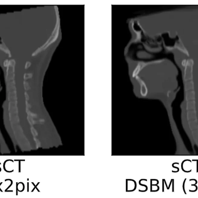 Diffusion Schrödinger Bridge Models for High-Quality MR-to-CT Synthesis for Head and Neck Proton Treatment Planning